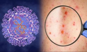Medicii anunță un nou caz de variola maimuței în România
